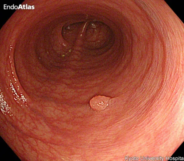 腺腫のイメージ画像