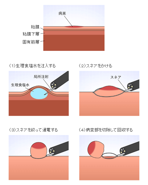 粘膜切除術（EMR）のイラスト図